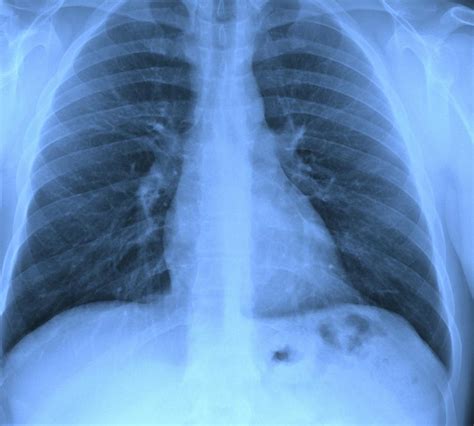 Can mould cause lung scarring?