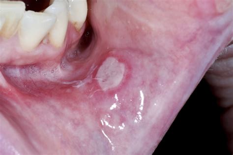Can mouth cancer look like an ulcer?