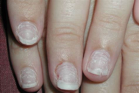 Can nails be permanently damaged?