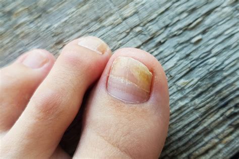 Can nails go back to normal after fungus?