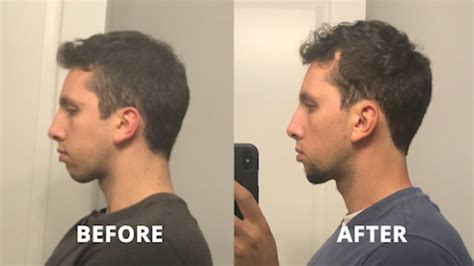 Can nose breathing fix my jawline?