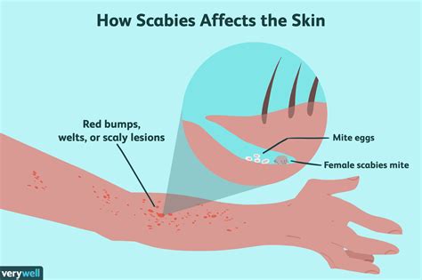 Can not showering cause scabies?