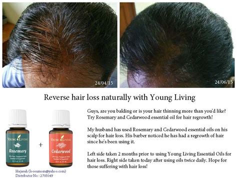 Can oils reverse hair loss?