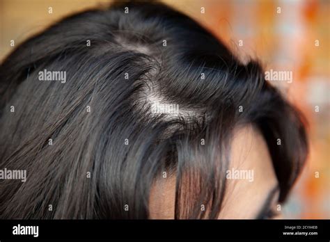 Can oily hair be genetic?