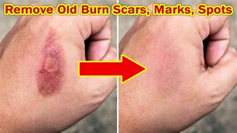 Can old burn scars be removed?