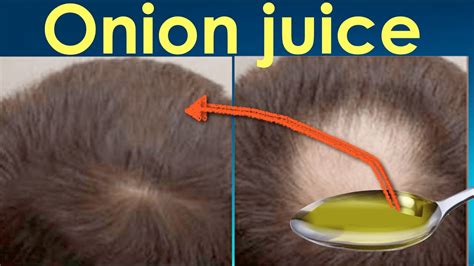 Can onion juice regrow edges?