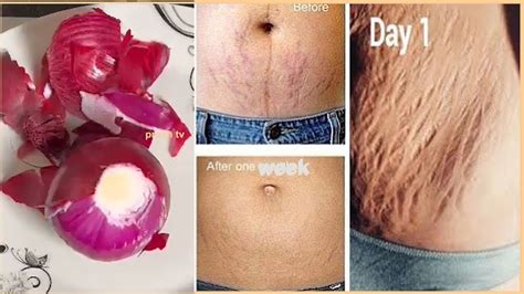 Can onion remove stretch marks?