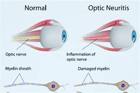 Can optic neuritis come and go?