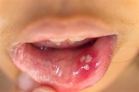 Can oral HPV go away?