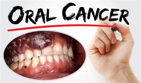 Can oral cancer cause death?