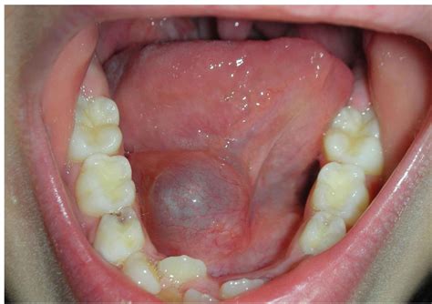 Can oral mucocele burst?