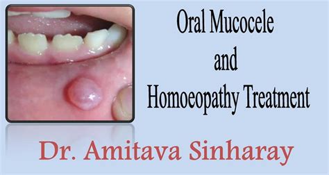 Can oral mucocele last years?