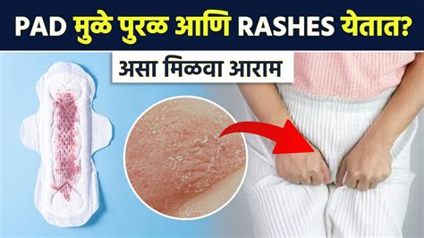 Can pads give you a rash?