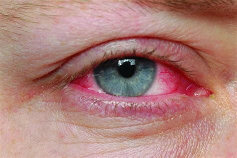 Can people's eyes be pink?