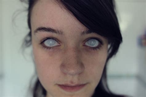 Can people have white eyes?