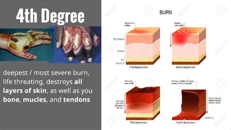 Can people survive 4th degree burns?
