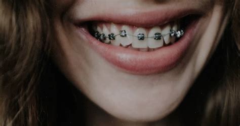 Can people with braces give hickey?