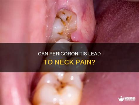 Can pericoronitis fall off?