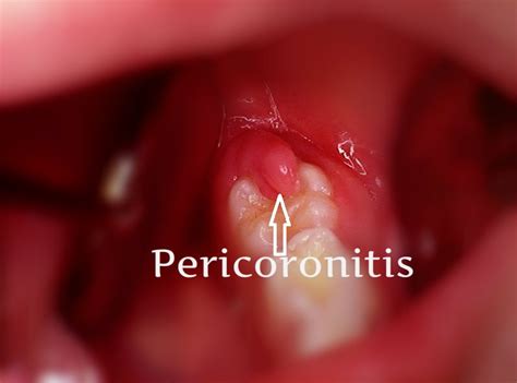 Can pericoronitis go away?