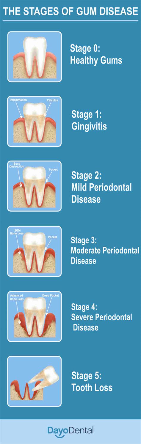 Can periodontitis be saved?
