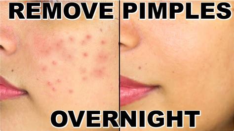 Can pimples go away overnight?