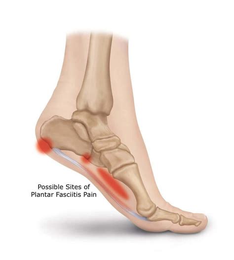 Can plantar fasciitis be mistaken for something else?