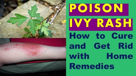 Can poison ivy go away in 3 days?