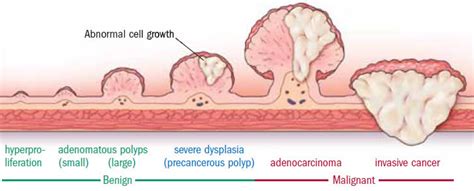 Can polyps grow and not be cancerous?
