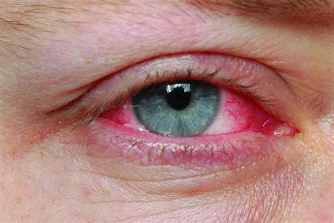 Can pool water cause pink eye?