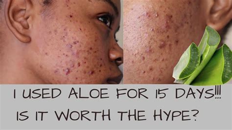 Can raw aloe vera cause acne?