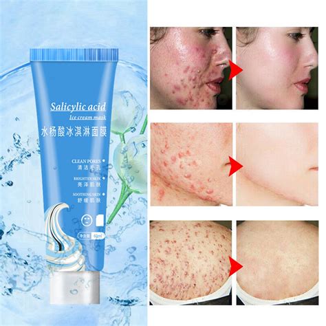 Can salicylic acid remove acne scars?