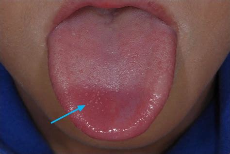 Can salt damage your tongue?