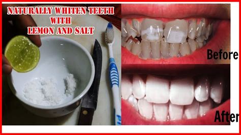 Can salt help teeth?