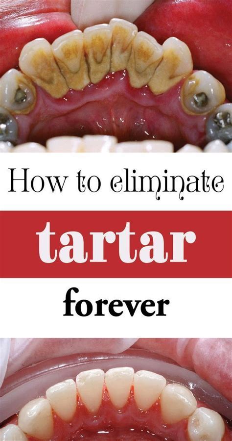 Can salt remove tartar from teeth?