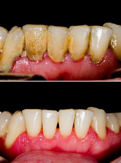 Can salt water damage gums?