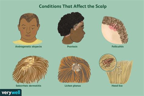 Can scalp fungus cause hairloss?