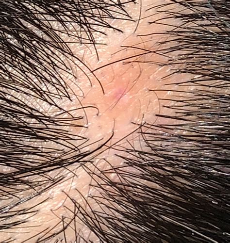 Can scalp picking cause hair loss?