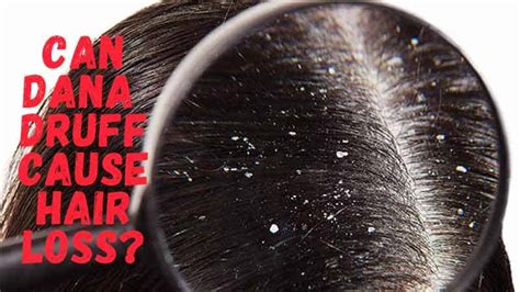 Can scratching off dandruff cause hair loss?