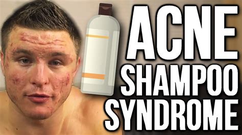 Can shampoo cause back acne?