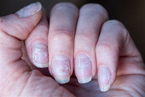 Can shellac cause nails to fall off?
