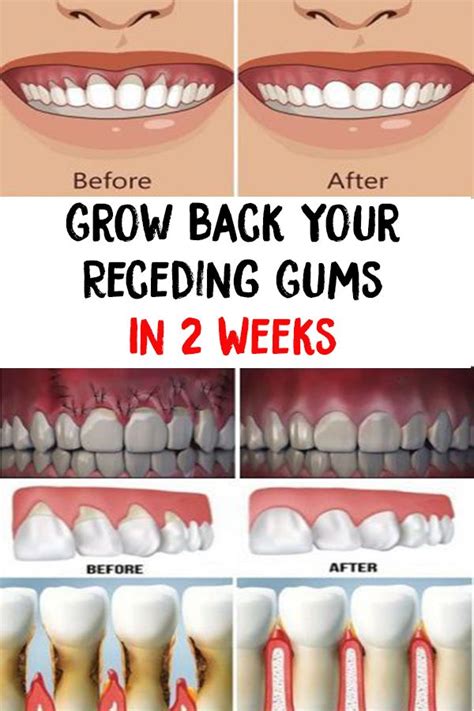 Can shrinking gums grow back?