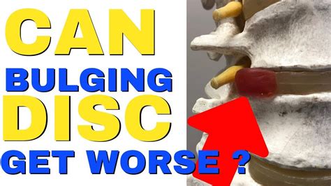 Can sitting make a bulging disc worse?