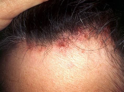 Can sitting too much cause folliculitis?