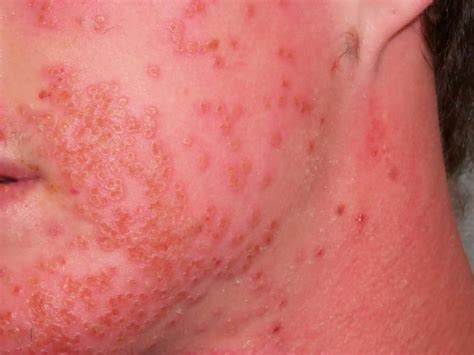 Can skin fungus go away on its own?