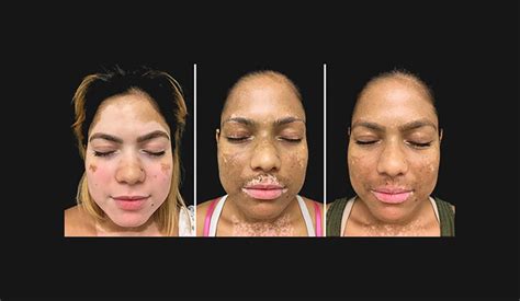 Can skin pigment be restored?