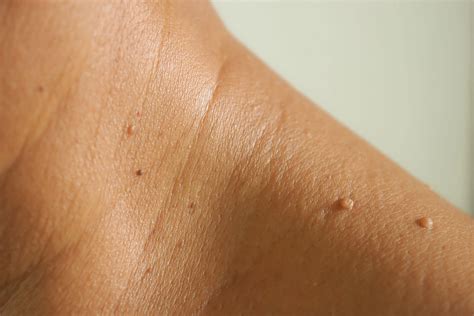 Can skin tags get worse?