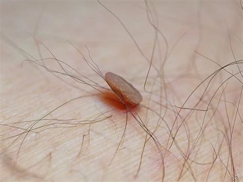 Can skin tags turn cancerous?