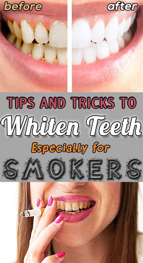 Can smokers teeth be whitened?