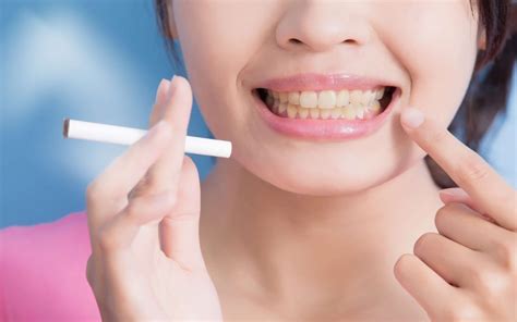 Can smokers whiten their teeth?