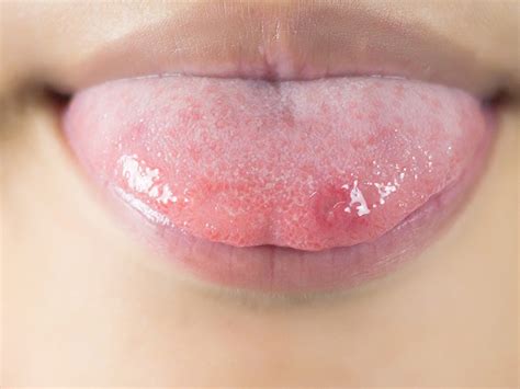 Can sour candy cause bumps on tongue?